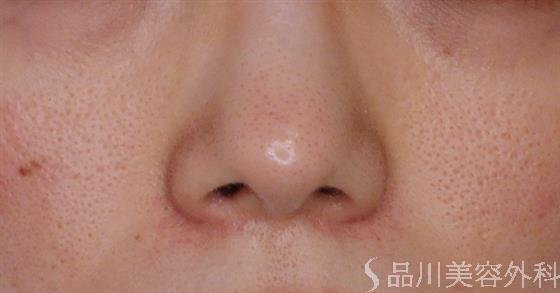 症例NO.52230のBEFORE写真