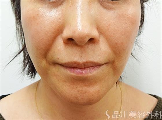 症例NO.32824のBEFORE写真