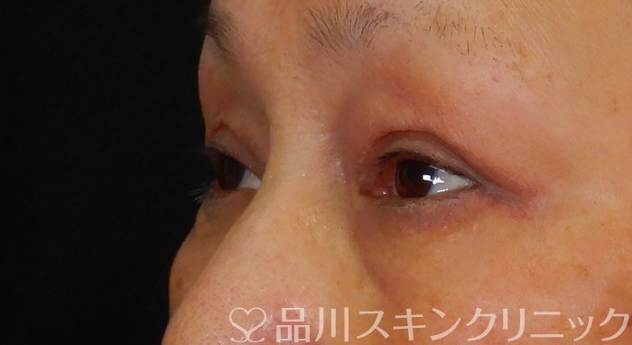症例NO.67398のAFTER写真