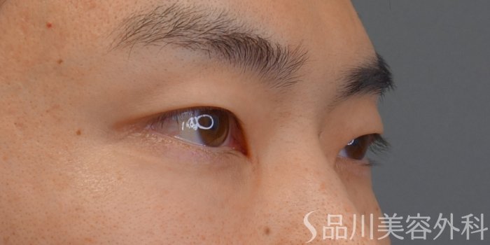 症例NO.74969のBEFORE写真