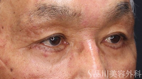 症例NO.69204のAFTER写真