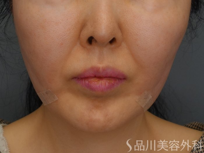 症例NO.73688のAFTER写真
