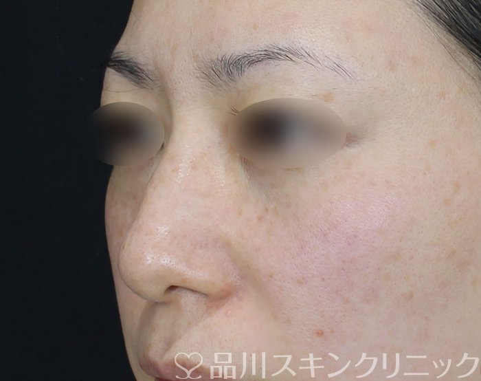 症例NO.69287のBEFORE写真