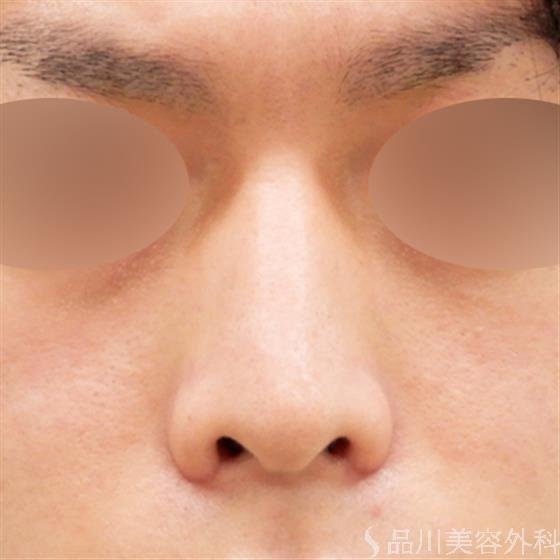症例NO.54385のAFTER写真