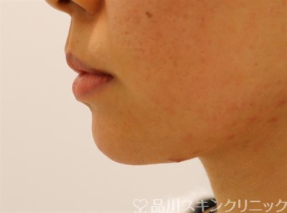 症例NO.38507のAFTER写真