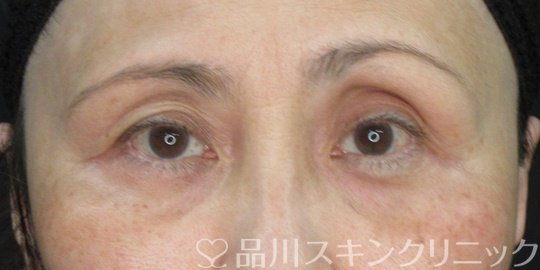 症例NO.73325のBEFORE写真