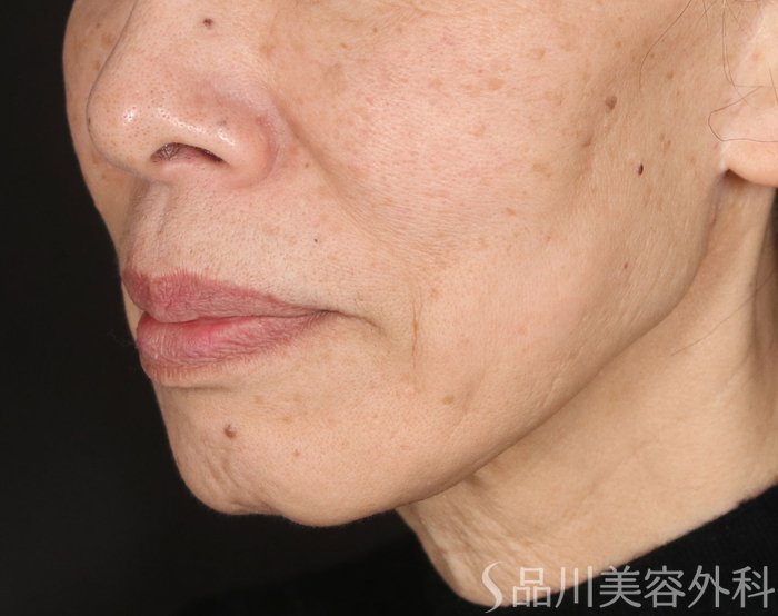 症例NO.72936のBEFORE写真