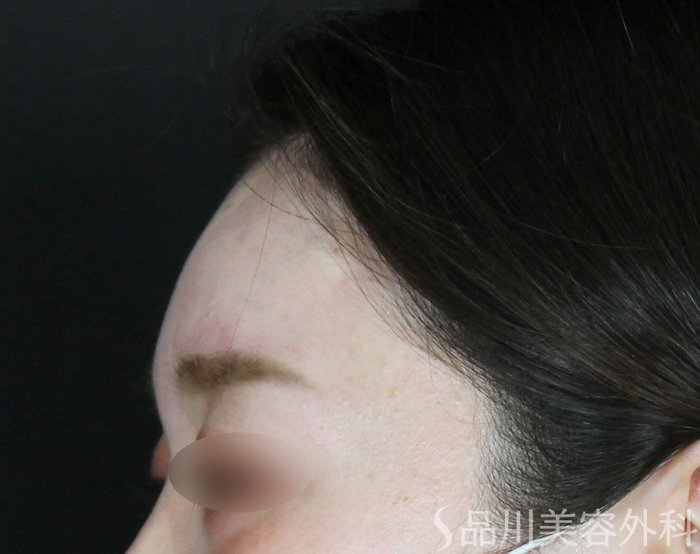 症例NO.73419のAFTER写真