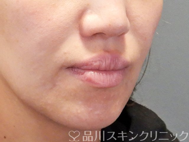 症例NO.71241のBEFORE写真