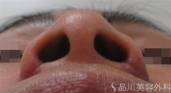 症例NO.21357のAFTER写真