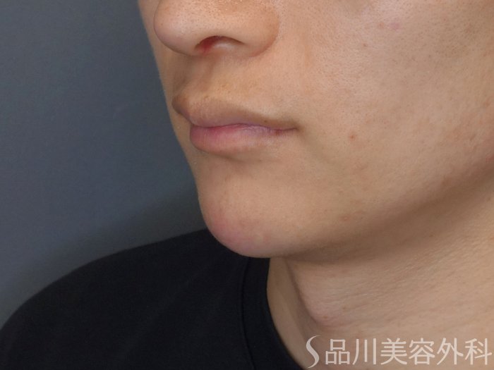 症例NO.70250のAFTER写真