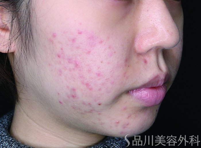 症例NO.73603のBEFORE写真