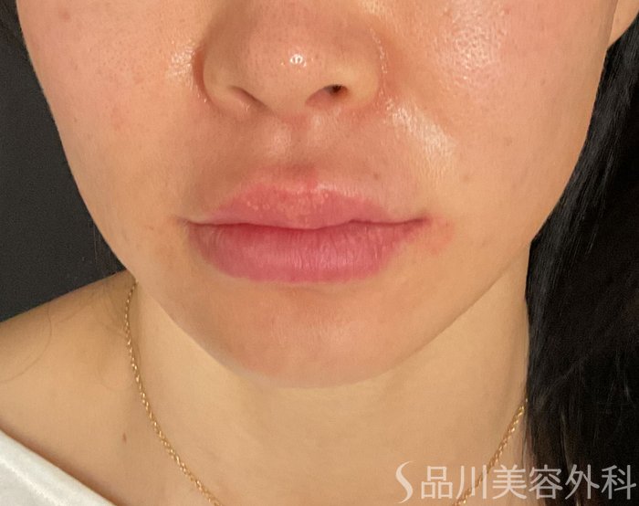 症例NO.75356のAFTER写真