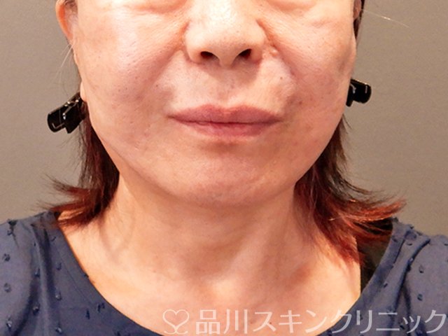 症例NO.71190のAFTER写真