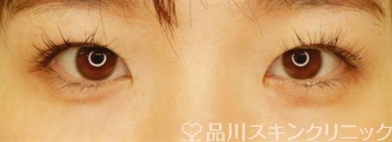 症例NO.54213のBEFORE写真