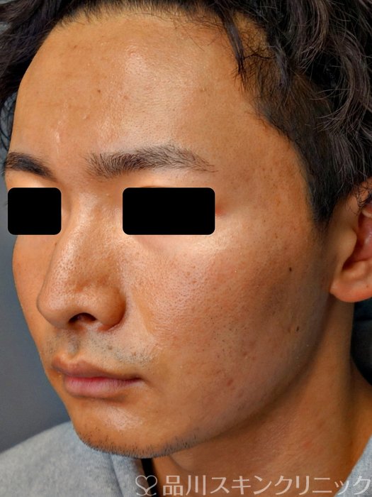 症例NO.73585のBEFORE写真