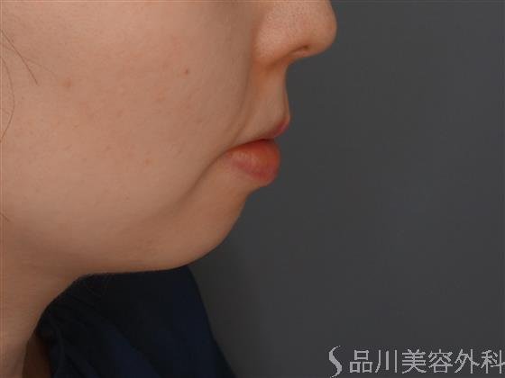 症例NO.60235のBEFORE写真