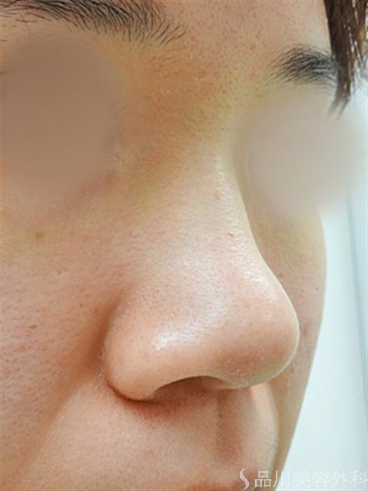 症例NO.30854のBEFORE写真