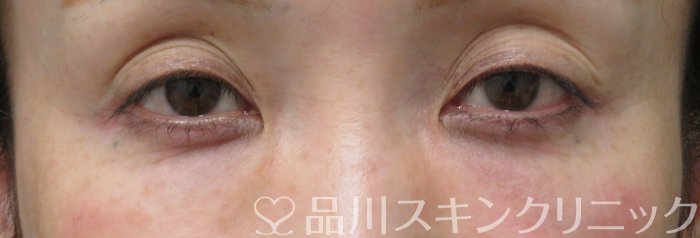症例NO.74737のAFTER写真
