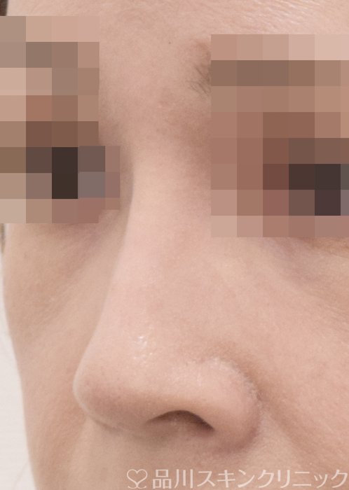 症例NO.71680のAFTER写真