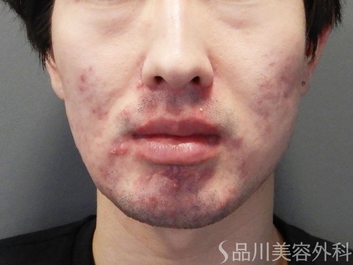 症例NO.72298のBEFORE写真