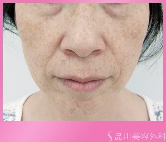 症例NO.1181のBEFORE写真