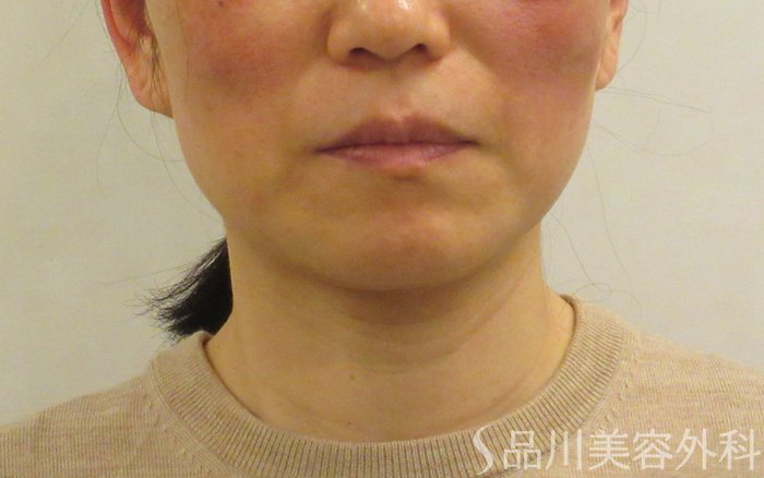 症例NO.72089のAFTER写真