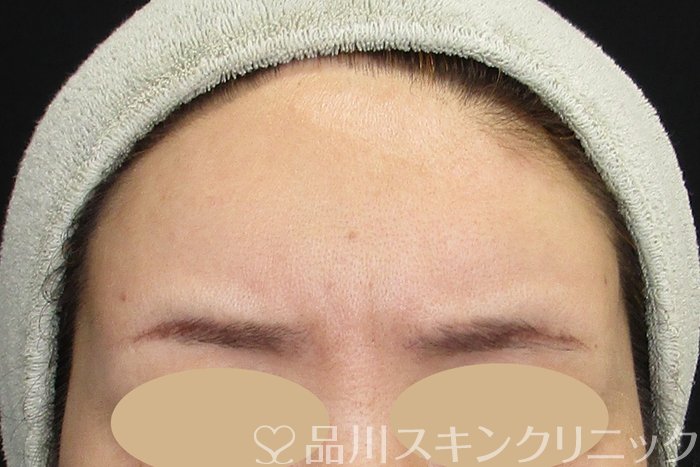 症例NO.74720のBEFORE写真