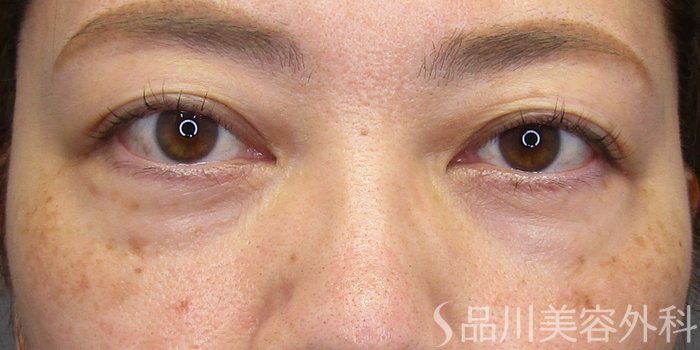 症例NO.75172のAFTER写真