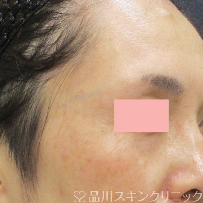 症例NO.72125のAFTER写真