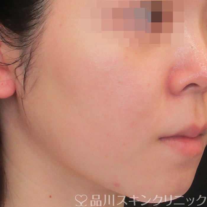 症例NO.75111のAFTER写真