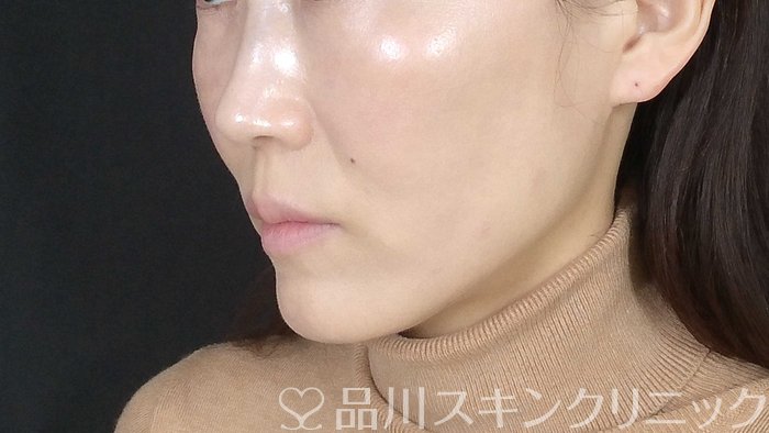 症例NO.72273のAFTER写真