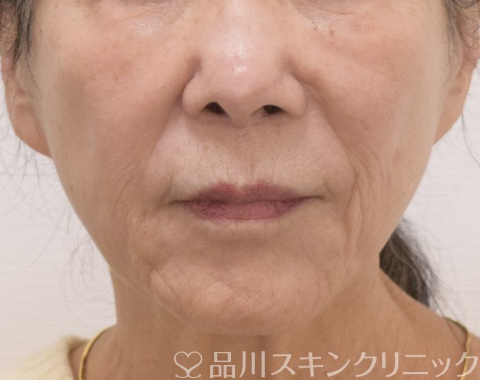 症例NO.73426のAFTER写真