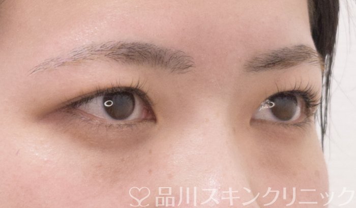 症例NO.71183のBEFORE写真