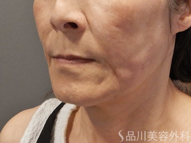 症例NO.71868のBEFORE写真