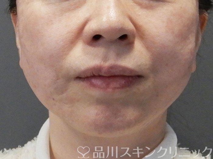 症例NO.73037のAFTER写真