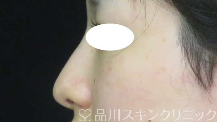 症例NO.74023のBEFORE写真