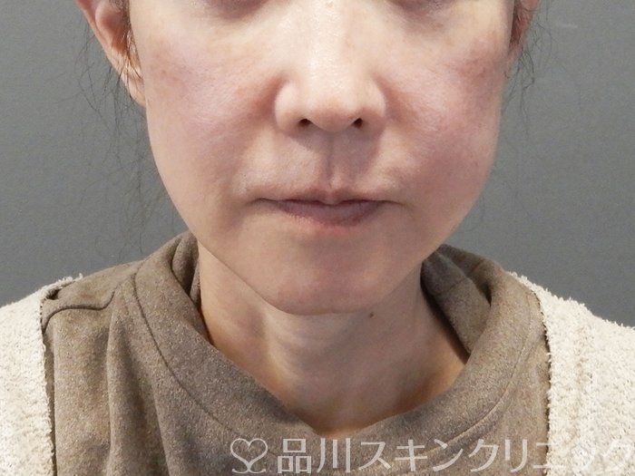 症例NO.73024のBEFORE写真