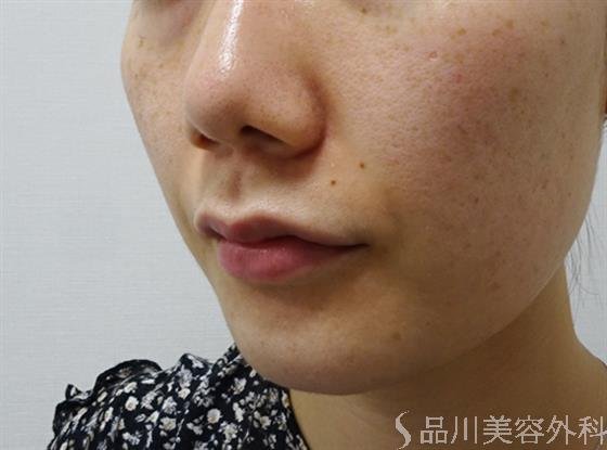 症例NO.51905のBEFORE写真