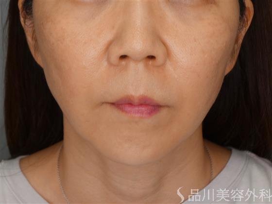 症例NO.53585のAFTER写真