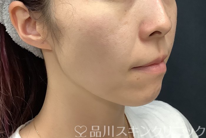 症例NO.69560のBEFORE写真