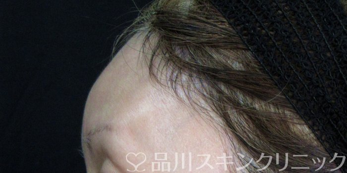 症例NO.74348のAFTER写真