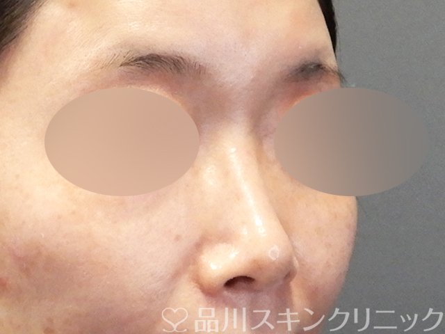 症例NO.68927のBEFORE写真
