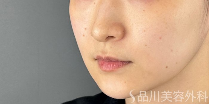症例NO.70252のBEFORE写真