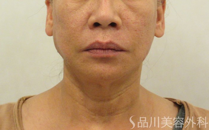 症例NO.71918のAFTER写真