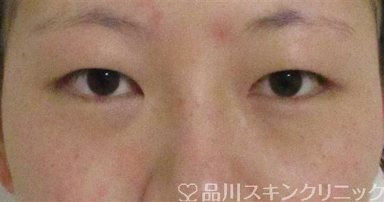 症例NO.60989のBEFORE写真