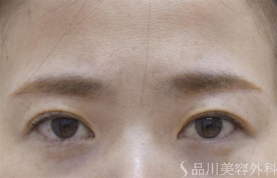 症例NO.54784のAFTER写真