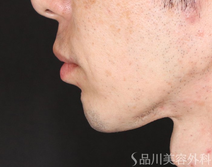 症例NO.71069のBEFORE写真