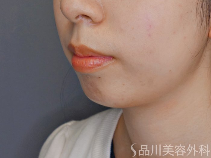 症例NO.70027のBEFORE写真