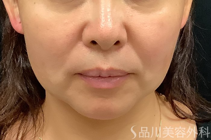 症例NO.71245のBEFORE写真